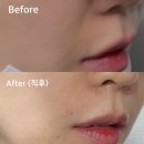기원섬유 | 팔자주름 퇴마기원 잼버실 리프팅 + 쥬베룩볼륨 후기 aka 필프팅