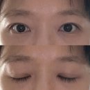 노화장 | 내돈내산 쌍수 인아웃 자연유착+지방제거 후기(2주차~3달차)
