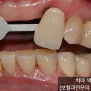차고기영치과의원 | [송곳니 임플란트, 송곳니 임플란트 브릿지] 치과대학병원 교수 출신 구강외과전문의가 자연스럽게 완성...