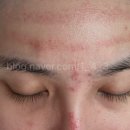 홍익약국 | 여드름 피부 재생일지 #1 엑소좀 엑소힐러 비추 후기 (내돈내산/효과/고통/붉은자국/사진후기)