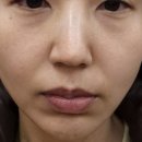 코그 | 신논현피부과 리프팅 후기 :: 볼처짐 코그실 + 사각턱필러로 얼굴선 정리한 날