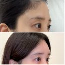 국산길 | 이마필러 내돈내산 국산채움 5cc 붓기 통증 등 세달차 후기 +병원 두군데 비교