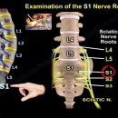 S1 신경근 검사(Examination of the S1 Nerve Root) 발바닥 힘이 약하다면? S1 신경근을 확인해야 합니다 이미지