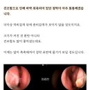 축농증 수술 후기 회복 변화 기록