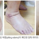 고지혈증약, 고혈압약에 의한 발 부종(함요부종) 의심 사례 개선. 기사 2025.6.17. 이미지