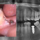 molar uprighting 이미지