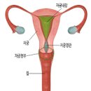 자궁경부암 원인 진단 예방접종 검사 자궁경부 반응성 세포변화 이미지