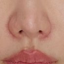 차옴 | 천안새살침 1회차 받고옴 코옆 패인흉터치료 후기, 신부동피부과 2주차 애프터사진있음