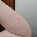 구례병원 | 지네 물려서 명절에 구례병원 응급실 다녀온 후기(지네사진 없음)