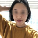 티오피성형외과의원 | 얼굴 지방이식 티오피성형외과에서 진행했어요