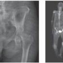 세균성 관절염 (Septic Arthritis) 이미지