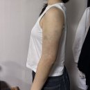 선스피닝짐 | 대구 반월당 팔지방흡입주사 당일~12일차 아픔 멍 붓기 꼼꼼하게 적은 솔직후기