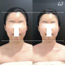 내 얼굴형에 딱 맞는 위뷰티 예쁜얼굴관리 후기