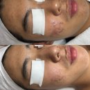 (주)에프알메디칼랩 | 대학 가기 전 여드름 없애고 싶은 고등학생 필독