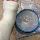 계단에서 넘어지고 200만원 쓴 후기 | 발목 전거비인대 완전파열, MRI 실비, 통깁스 방수커버