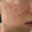 용한의원 | 여드름흉터치료 새살침 한의원 1회 후기 가격 부작용 비교