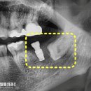 검단일등치과의원 네이버블로그
