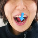 한일치과의원 | 무턱 교정 비용만으로, 수술 2배 효과 봤습니다!