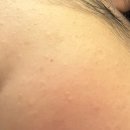 11620-전10-46-2 | 결혼 46일 앞두고 10만 원 대로 편평사마귀 100개 제거한 내돈내산 후기 (1~6일차)