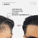 더문 | 콤마더문대구, SMP탈모커버 후기로 증명합니다