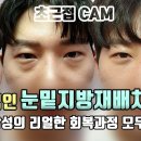 [4K] 눈밑지방재배치로 깔끔해진 인상, 20대 남성의 눈밑은 어떻게 달라졌을까? 이미지