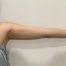 지힐링스퀘어의원 | 지방 추출 미니 지방 흡입으로팔뚝 군살정리 3주차 후기 [지힐링스퀘어의원]
