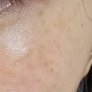 에스앤유의원 | 서울 오타모반 치료 잘하는 피부과 마포공덕 에스앤유피부과 후천성 오타모반, 기미,주근깨 레이저 1...