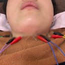 명동윤곽침 이중턱한의원 1회 시술 턱라인리프팅 후기