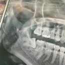 네이버구강악안면외과치과의원 | 👣 | 잠실숲사랑니구강악안면외과치과의원 : 매복사랑니 발치 후기