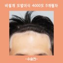 (주)모네상스 | [모네상스 제휴병원] 머리의 생명은 헤어라인이다! M자 탈출 모발이식