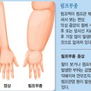 유방암 수술 후 팔 림프 부종의 치료와 관리 ​ 이미지
