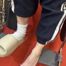 엄지약국 | 엄지 발가락 탈구 + 골절 핀삽입 수술, 6주 후 핀 제거 후기