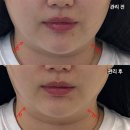 (주)웨이포인트 | [원웨이랩][실사용 후기] 1회만으로도 달라지는 페이스 윤곽 / 웨이밤_뷰티✨
