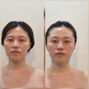 오늘,동안 - 수원시 권선구 금곡동 | 자양동 신부관리 안아픈 얼굴윤곽관리 오늘 동안 자양한강점 솔직후기