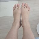 역곡정형외과의원 | [9월 4주차] 절름발이가 되었다.