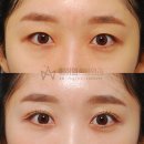 숨은그림성형외과의원 | 눈 216. 쌍수 인아웃라인 연예인, 눈밑지방재배치 수술 후기, 비용