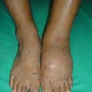 Neuropathic arthropathy 이미지