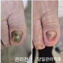 아르떼뷰티앤레푸스하남 | 여름 오기 전에 꼭 가야 할 하남 발톱무좀 아르떼뷰티앤 레푸스 하남 후기