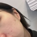 안아파한의원 | 범계 여드름 클리닉 한의원 _ 여드름 압출 진정 2회차 / 한약 복용 3주차 후기