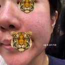 명심약국 | 포텐자 한 달 후기 내돈내산 모공 부자 모공 팁으로 얼굴 전체 1회 추천은 합니다 다만...