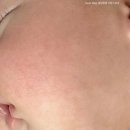 티시엠 | 생후 3개월, 갑작스러운 아토피 진단받은 2일 차(with. 산양분유에서 특수분유로 갈아타기)