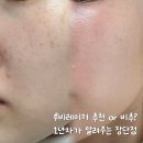 루비 | 루비레이저 후기 2탄 일주일 ~ 1년 후, 주근깨 효과와 홍조 부작용