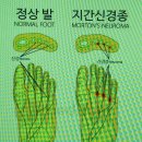 발바닥 통증의 대표적인 지간신경종 부주상골증후군 족저근막염-발가락운동용구 듀트 이미지