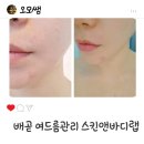 시흥 여드름 모공관리 스킨앤바디랩 배곧본점 후기