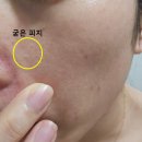 (유)희망케어 | 영통 여드름케어 및 압출 전문 리솔르에스테틱 + 1주일 후기