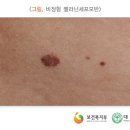 멜라닌세포모반 melanocytic nevus 이미지