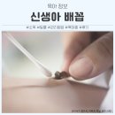배꼽친구 | 신생아 배꼽소독 알콜 관리 방법 및 육아종 후기