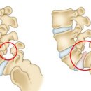 허리를 소중히! 척추분리증수술 후기 (오래됨주의) 이미지