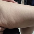 메디핸즈 지방연구소 후기 뱃살이랑 허벅지 셀룰라이트 고민일 때 홈케어로