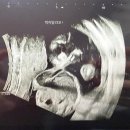 임신17주~24주 기록(신경관결손 고위험 정밀초음파, 전치태반 정상, 임당검사, 임당재검확정, 임당재검...